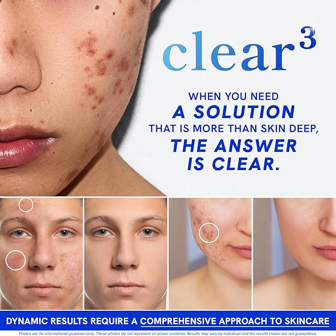Clear Skin Acne Supplement with Zinc, DIM & Probiotics | 3-in-1 Balance, Clarify, Restore Support with Hyaluronic Acid & Skin Support Vitamins | for Women & Men | Oral Hormonal Acne Pills | 180 Ct