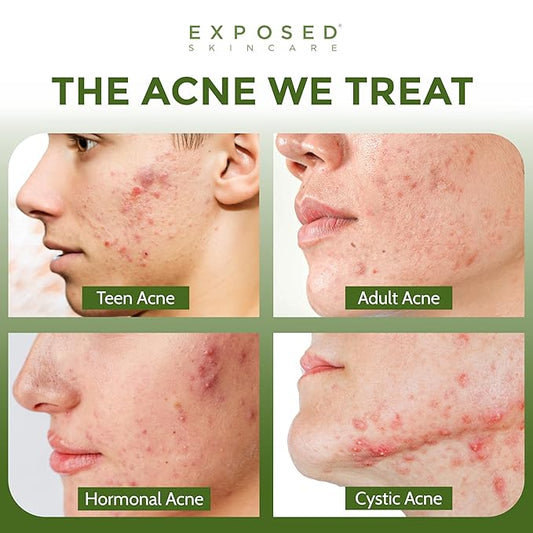 Exposed Skin Care Clearing Tonic Facial Toner with 1% Salicylic Acid and Witch Hazel for Acne Treatment – Pore Minimizing Toner to Prevent Breakouts, Reduce Redness and Balance Skin – Step 2 (4 fl oz)